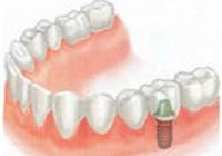 Имплантация - эффективный способ восстановления зубов