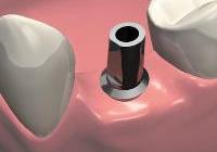 Имплантация зубов – современный способ восстановить красоту улыбки